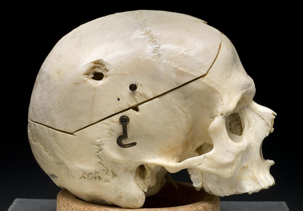 Gunshot skull.jpg