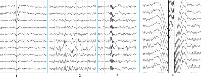 File:Human EEG artefacts.png