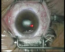 Fayl: Lasik UOC.ogv