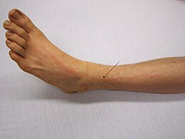 A person who was affected by a nearby lightning strike. Note the slight branching redness traveling up the victim's leg from the effects of the current. Lightning injury.jpg