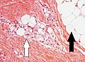 Lipoblasts and lipocytes.jpg