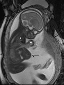 MRI of a fetus with Pentalogy of Cantrell. MRI of a fetus with pentalogy of Cantrell.jpg