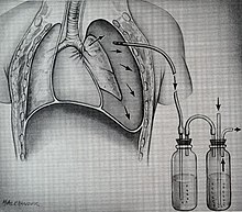 An example of a chest tube Main bronchus laceration.jpg