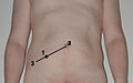 Location of McBurney's point (1), which is located two thirds the distance from the umbilicus (2) to the anterior superior iliac spine (3)