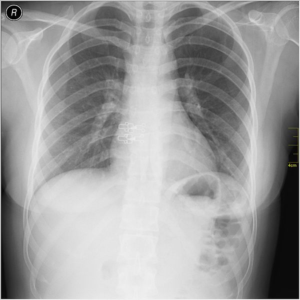 File:Medical X-Ray imaging PVL06 nevit.jpg