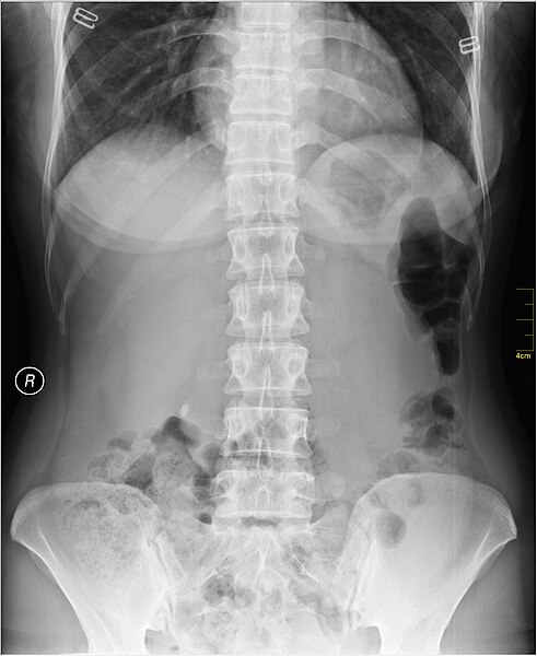 File:Medical X-Ray imaging RKQ07 nevit.jpg