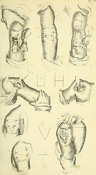 File:Operative surgery illustrated - containing more than nineteen hundred engravings - including two hundred original, and fifty colored drawings- with explanatory text (1852) (14578894260).jpg