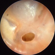 Միջին ականջի քրոնիկ բորբոքում