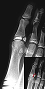 Salter–Harris IV fracture of big toe proximal phalanx.
