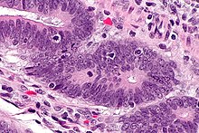 Tumour-infiltrating lymphocytes - 1 -- very high mag.jpg