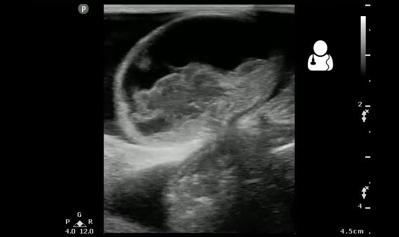 ملف:UOTW 44 - Ultrasound of the Week 1.webm