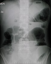 Upright abdominal X-ray demonstrating a small bowel obstruction. Note multiple air fluid levels. Upright abdominal X-ray demonstrating a bowel obstruction.jpg