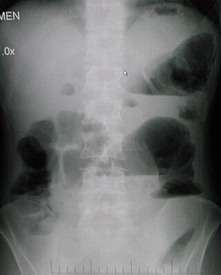 Obstrucción intestinal - Wikipedia, la enciclopedia libre