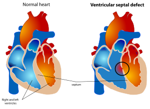 Ventricular septal defect.svg