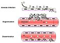 Aspergillus fumigatus Invasive Disease Mechanism Diagram.jpg