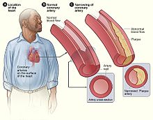 Coronary Arteries Wikipedia