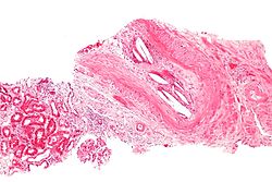 صورة مجهرية توضح صمة كولسترولية في شريان كلوي متوسط الحجم.