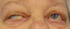 Косоокість та птоз у хворого на міастенію гравіс, що виникають при намаганні відкрити очі