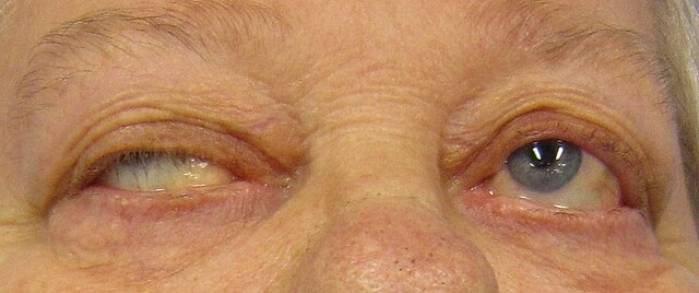 A) Small ptosis after breast feeding with a hands up test positif; (B)