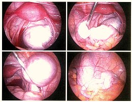 Opis obrazu Endometriosis.jpg.