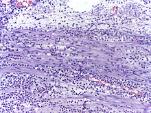 Micrograph showing several neutrophils during an acute inflammation Neutrophils -1.jpg