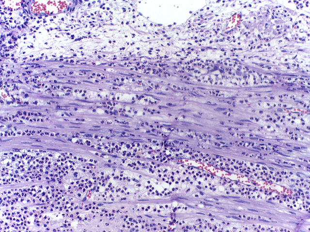 Micrograph showing several neutrophils during an acute inflammation