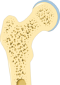 Osteoporosis