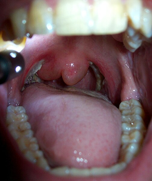 File:Post Tonsillectomy Uvula Swelling.jpg