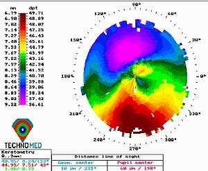 English: Preoperative corneal topography in a ...