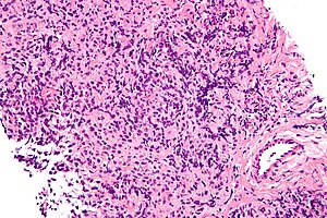 Primer mediastinum besar B-sel limfoma - tinggi mag.jpg