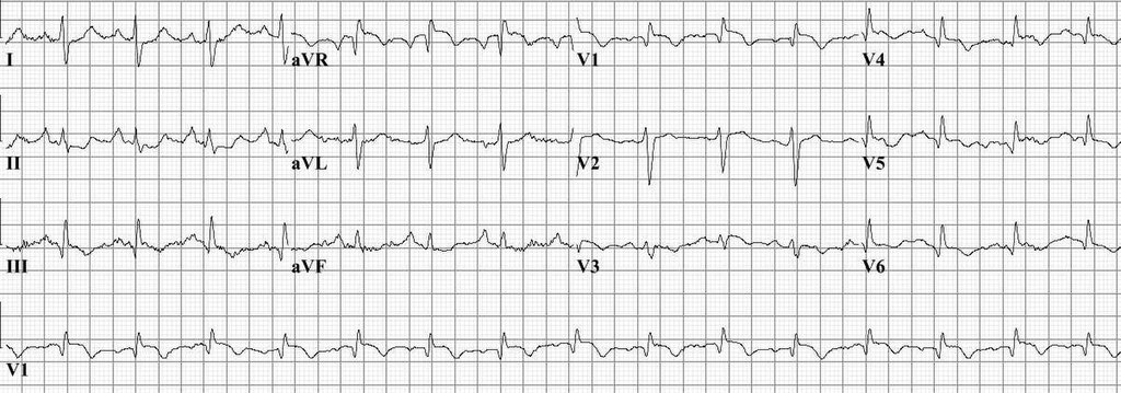 Pulm embolism