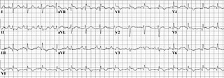 Right heart strain