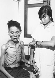 Starved Vietnamese man