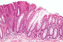 Micrograph of a mucinous adenocarcinoma Tubular adenoma 2 intermed mag.jpg