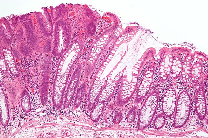 Ficheiro:Tubular adenoma 2 intermed mag.jpg