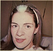 Woman with Waardenburg syndrome type 2, showing heterochromia and white forelock Waardenburg Syndrome 1.jpg