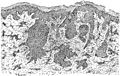 Figure 48. Section from rodent ulcer. The section is tekn from a part which was not ulcerated and show the typical collection of cells, some of which have a whorled arrangement. 50x