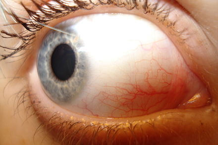 Image of a human eye showing the blood vessels of the bulbar conjunctiva