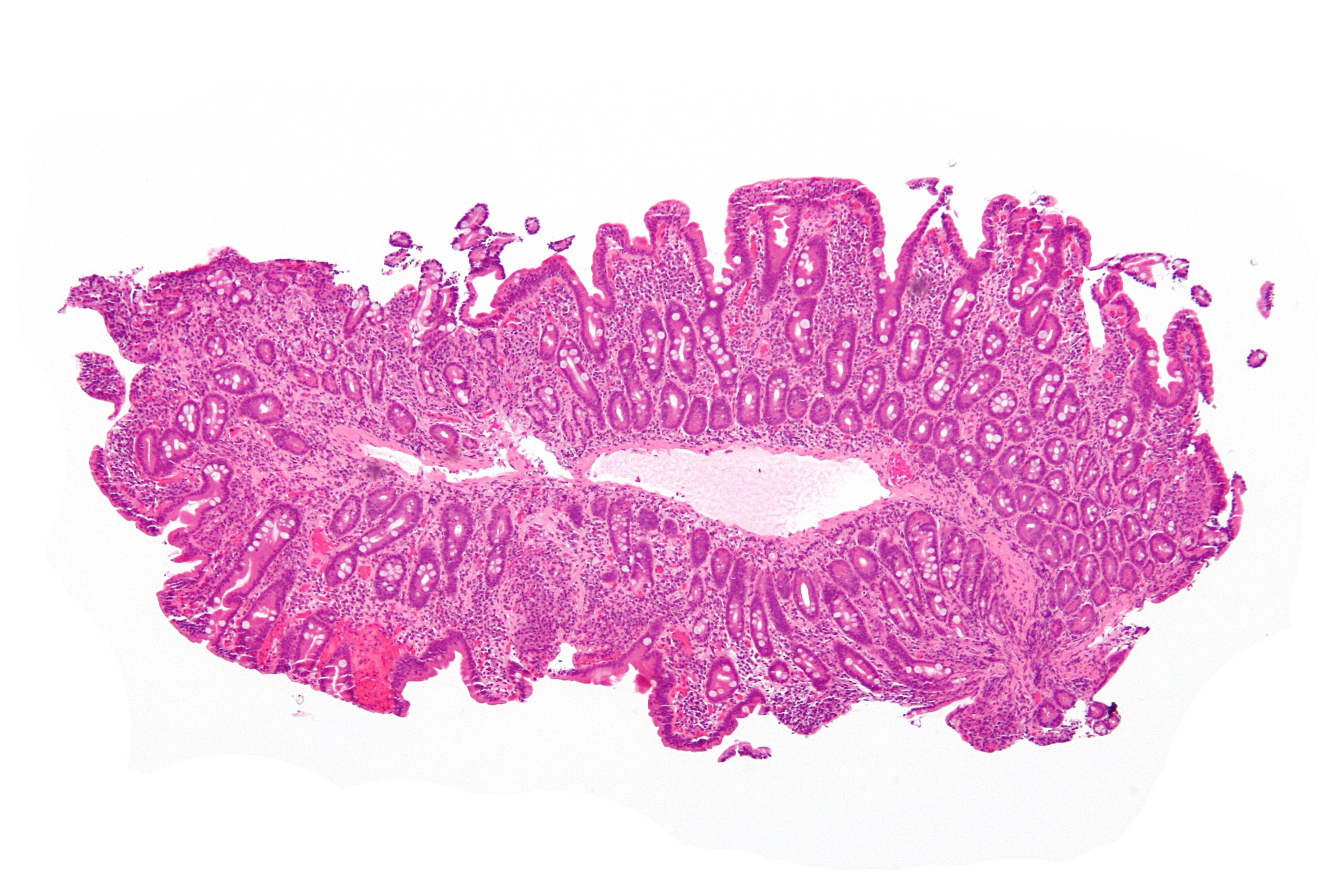 Hepatocellularis carcinoma