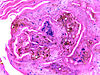 Chromoblastomycosis 40x.jpg