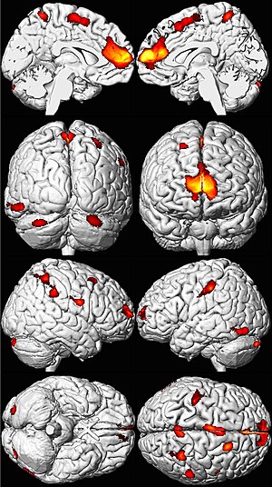 Eight MRI views of a brain in black and white, with yellow, orange, and red areas overlaid in spots mainly toward the front.