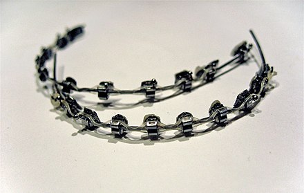 Dental braces, with a transparent power chain, removed after completion of treatment.