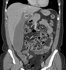 Coronal CT scan of a person initially suspected of having appendicitis because of right-sided pain. The CT shows in fact an enlarged inflamed gallbladder that reaches the right lower part of the abdomen. Enlarged gallbladder with gallstone and cholecystitis.jpg