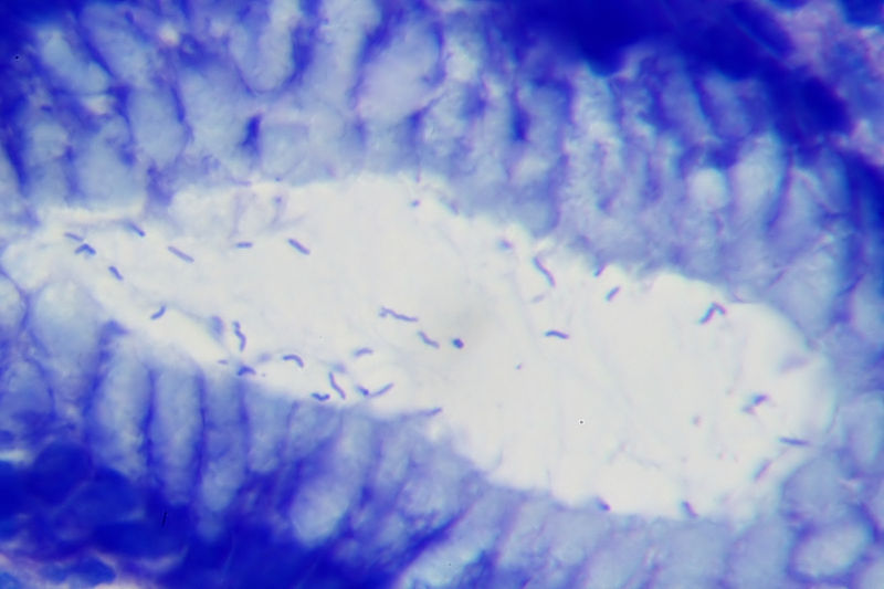 File:Helicobacter pylori in a case of gastritis.jpg
