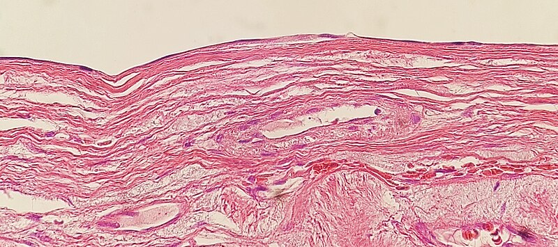File:Histopathology of simple squamous cyst wall.jpg
