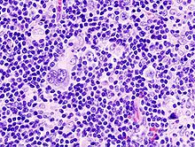 non hodgkins lymphoma cells