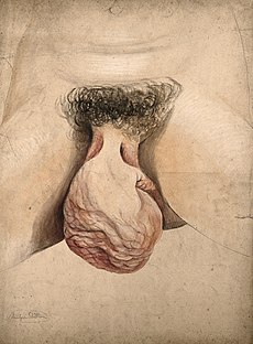 Hypertrophy of clitoris, 1857.jpg
