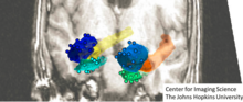 Figure depicting three medial temporal lobe structures amygdala, entorhinal cortex and hippocampus with fiducial landmarks depicted as well embedded in the MRI background. Medial-temporal-lobe-structures.png