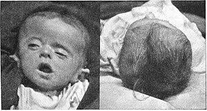 Plagiocephaly Greig.jpg