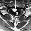 Thumbnail for Myelomalacia